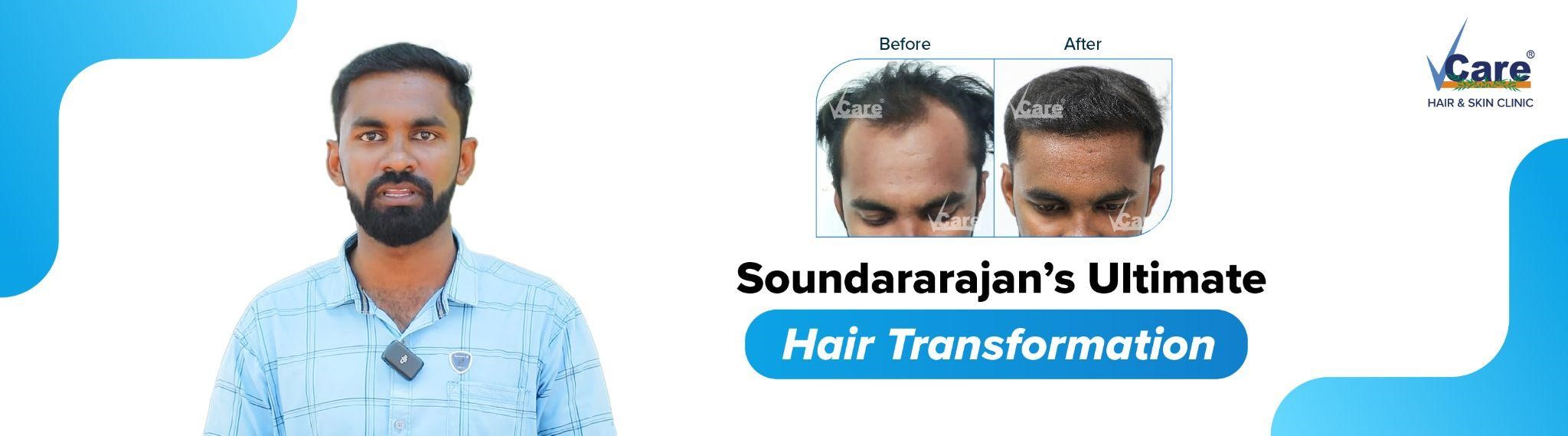REVERSING BALDNESS WITH VCARE 